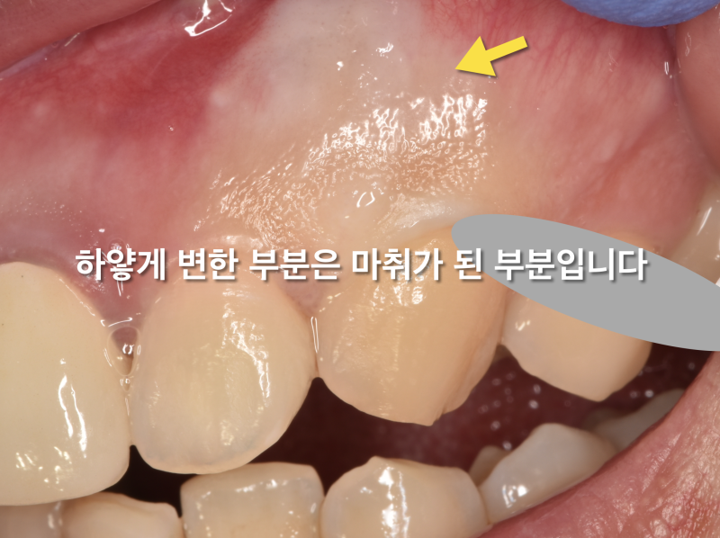 [치과 무통마취 동영상] 무통마취의 시작은 잇몸 무통마취부터 사진 2