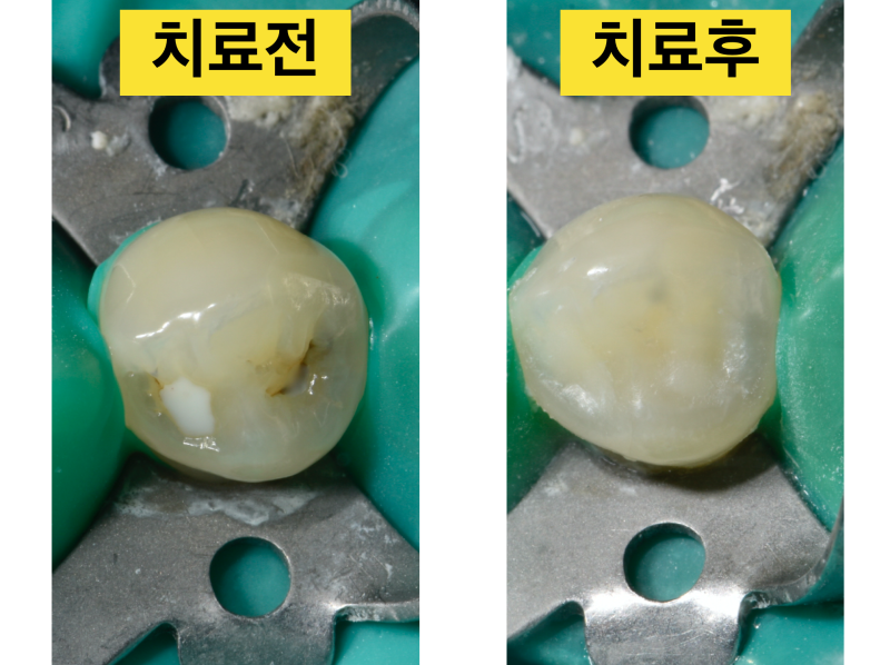치아 충치치료에서 레진, 인레이 그리고 크라운 어떻게 할까? 사진 4