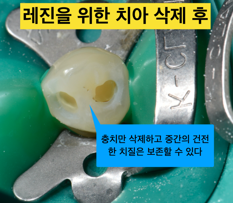 치아 충치치료에서 레진, 인레이 그리고 크라운 어떻게 할까? 사진 3