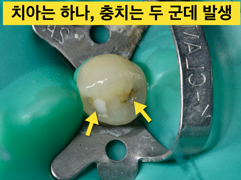 치아 충치치료에서 레진, 인레이 그리고 크라운 어떻게 할까?