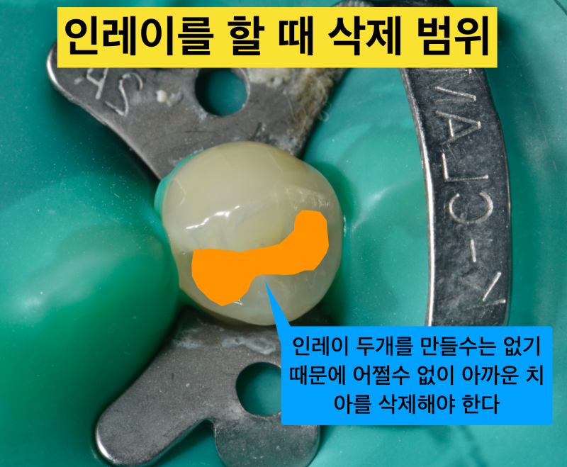 치아 충치치료에서 레진, 인레이 그리고 크라운 어떻게 할까? 사진 2