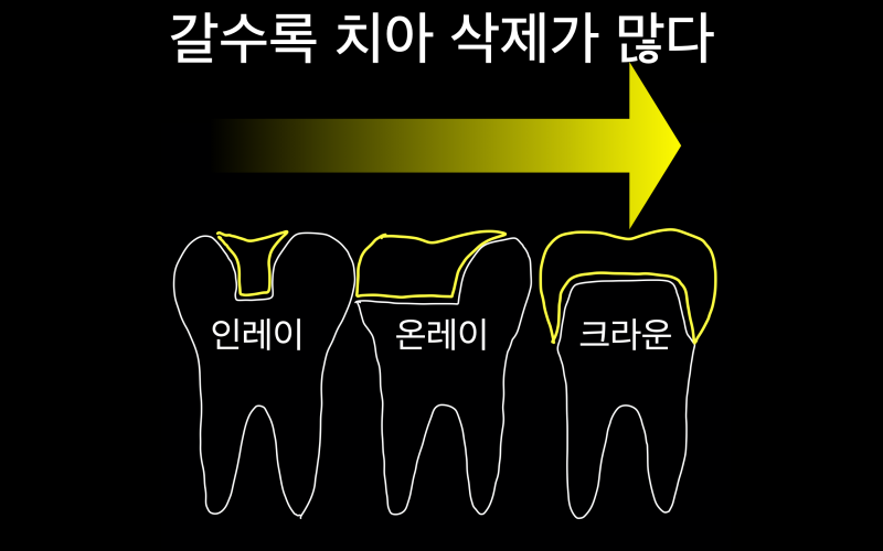 치아 최소 삭제 세라믹 크라운 치료 과정