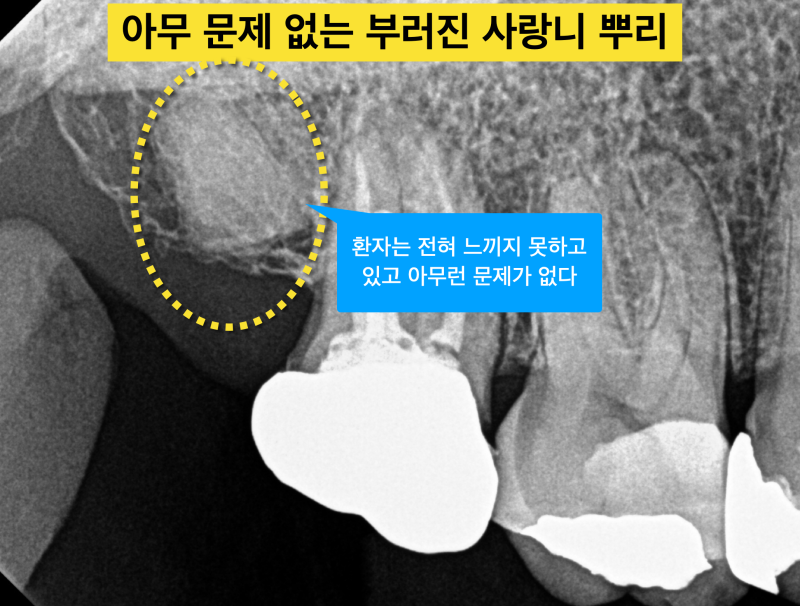 [사랑니 발치] 사랑니 뿌리가 남아 있어요. 어떻게 해야 하나요 ?