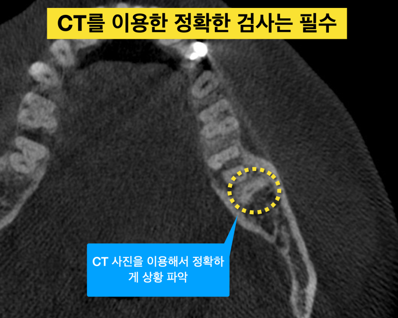 [사랑니 발치] 사랑니 뿌리가 남아 있어요. 어떻게 해야 하나요 ? 사진 2