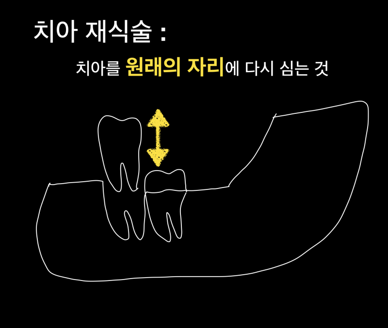 [자연치아 살리기] 내 치아 살리는 치아재식술과 자가치아이식술에 대해서 사진 2