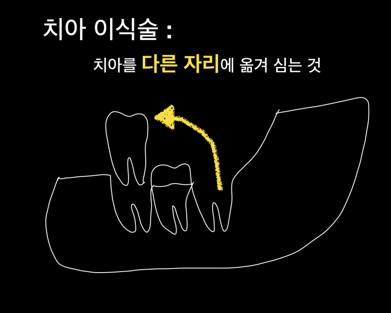 [자연치아 살리기] 내 치아 살리는 치아재식술과 자가치아이식술에 대해서 사진 3