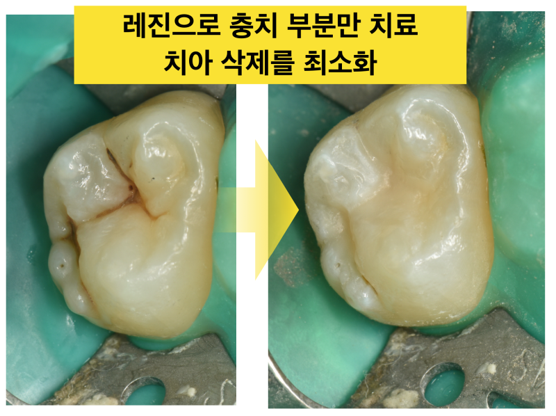 [레진 충치치료] 초기 충치라면 레진 치료가 인레이보다 좋다 사진 3