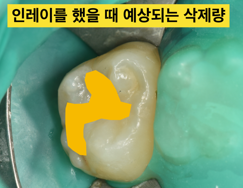 [레진 충치치료] 초기 충치라면 레진 치료가 인레이보다 좋다 사진 2