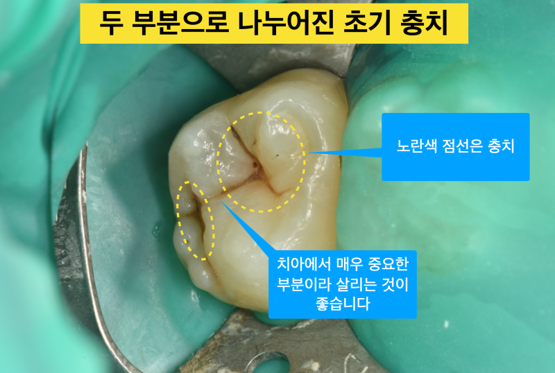 [레진 충치치료] 초기 충치라면 레진 치료가 인레이보다 좋다