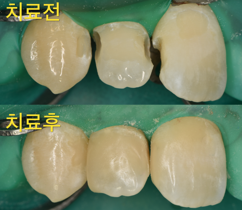[앞니 레진 치료] 앞니는 할 수 있으면 레진이 좋다