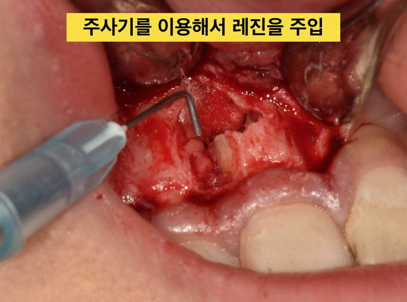 [치근단 수술, 치근단 절제술]치아를 살리는 치근단 수술의 최신 경향 - 역충전은 MTA 가 좋을까 ? 사진 3