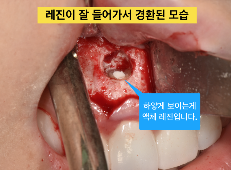 [치근단 수술, 치근단 절제술]치아를 살리는 치근단 수술의 최신 경향 - 역충전은 MTA 가 좋을까 ?