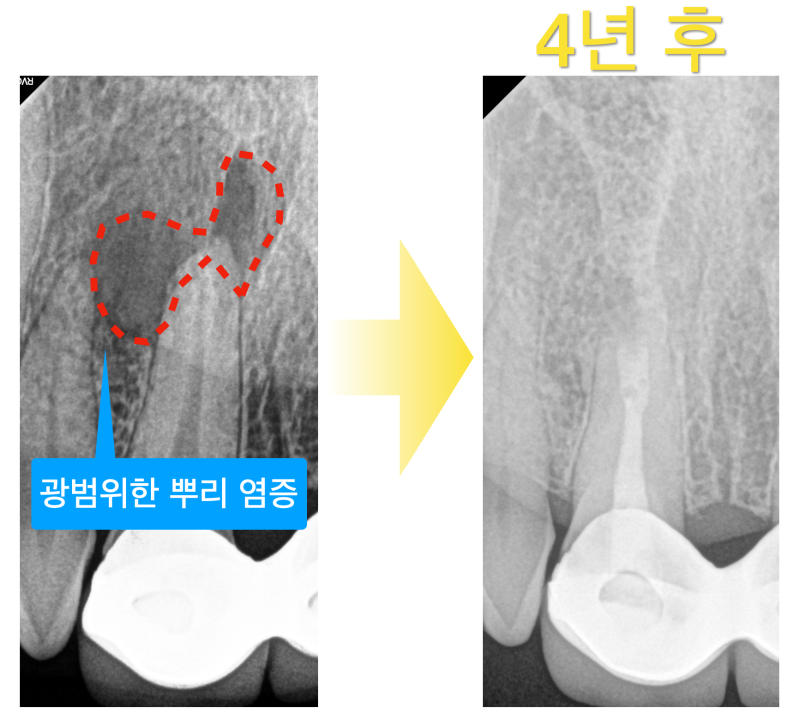 [치근단 절제술, 치근단수술] 신개념으로 치료한 4년 증례 그리고 변화를 따라가기 사진 2