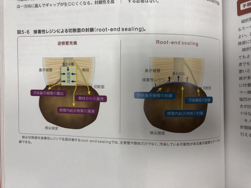 [치근단 절제술, 치근단수술] 신개념으로 치료한 4년 증례 그리고 변화를 따라가기