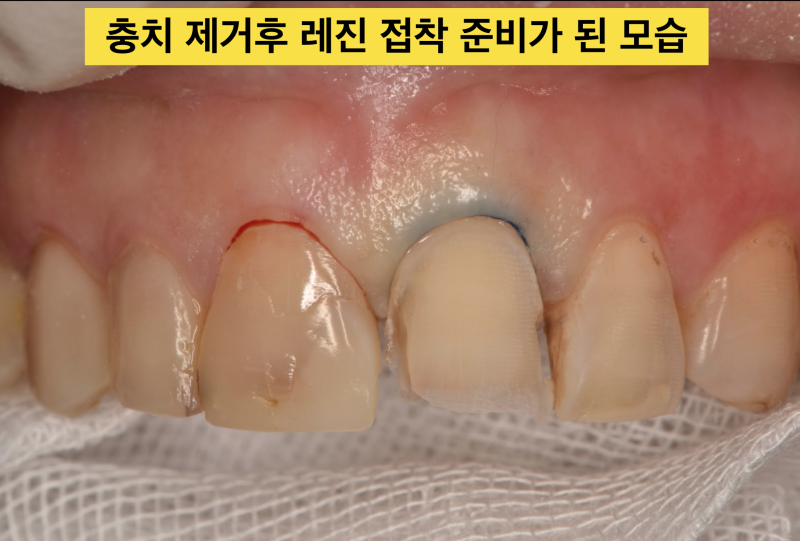 앞니 레진 치료, 레진 라미네이트로 치아 삭제 최소화한 경우 사진 2