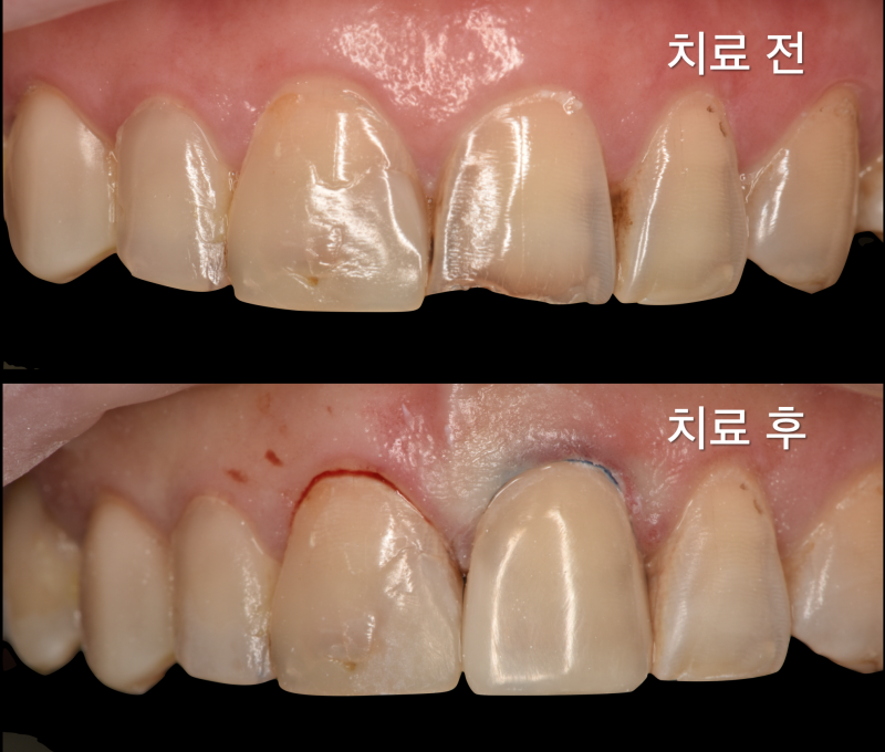 앞니 레진 치료, 레진 라미네이트로 치아 삭제 최소화한 경우 사진 3