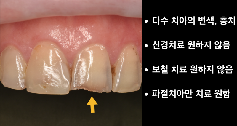 앞니 레진 치료, 레진 라미네이트로 치아 삭제 최소화한 경우