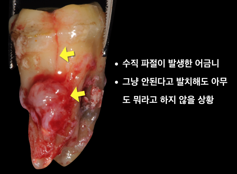크랙치아(crack tooth), 금이 간 치아를 치료 재식술로 살린 증례