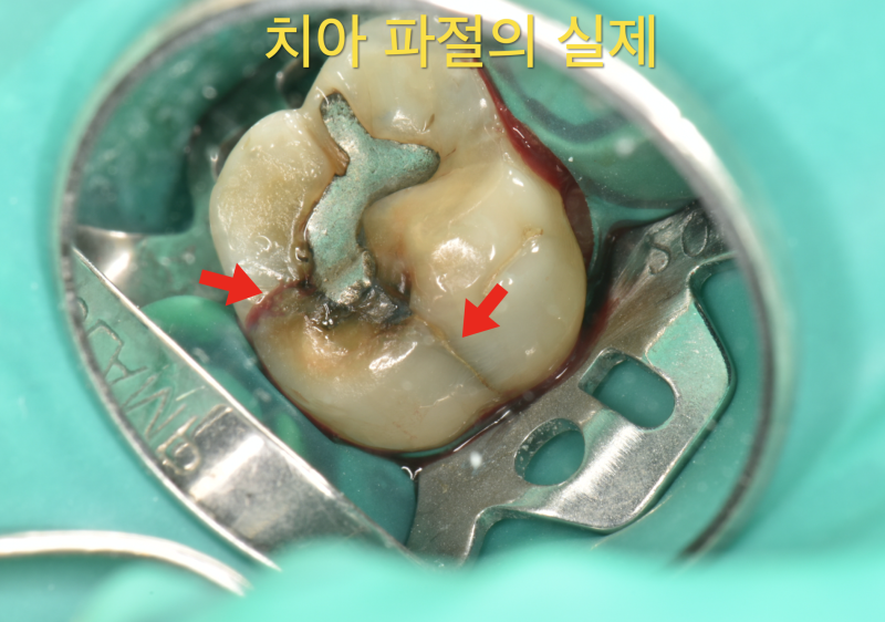 크랙치아(crack tooth), 금이 간 치아를 치료 재식술로 살린 증례
