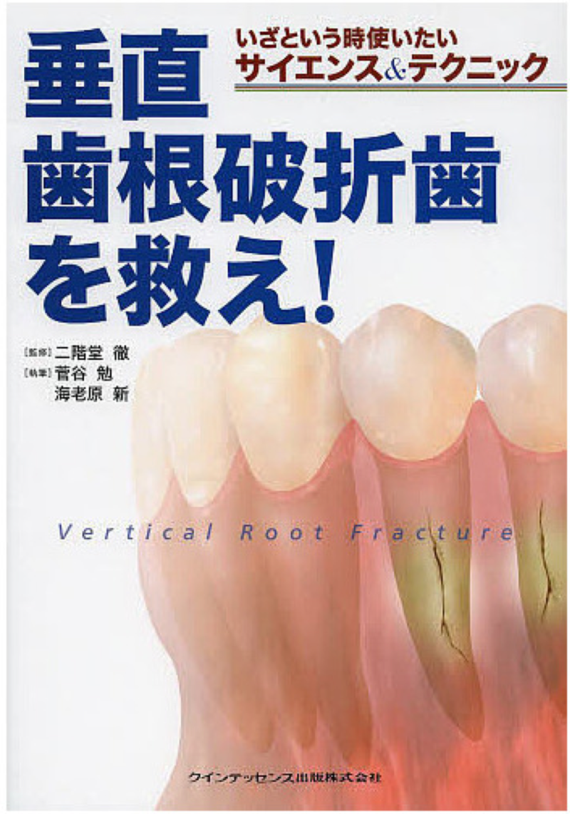 크랙치아(crack tooth), 금이 간 치아를 치료 재식술로 살린 증례 사진 2