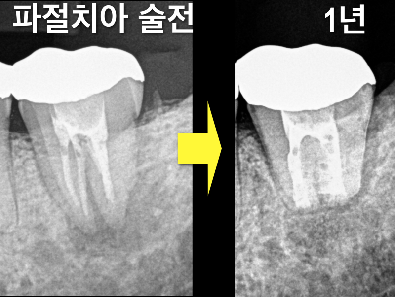 크랙치아(crack tooth), 금이 간 치아를 치료 재식술로 살린 증례 사진 6