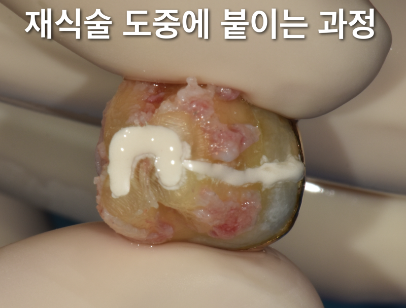 크랙치아(crack tooth), 금이 간 치아를 치료 재식술로 살린 증례 사진 5