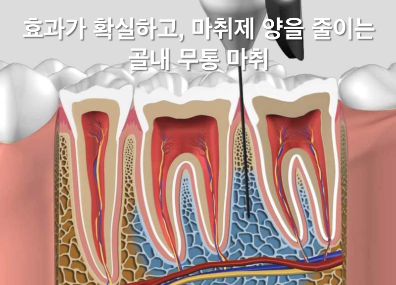 [무통 마취를 알아보자] 치과 마취가 안될때, 양보다 질이 중요하다. 사진 3