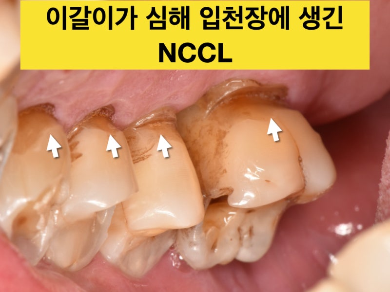 [치경부 마모, 치경부 레진]Part 1 치경부 마모증이 생기는 이유 3 가지 사진 4