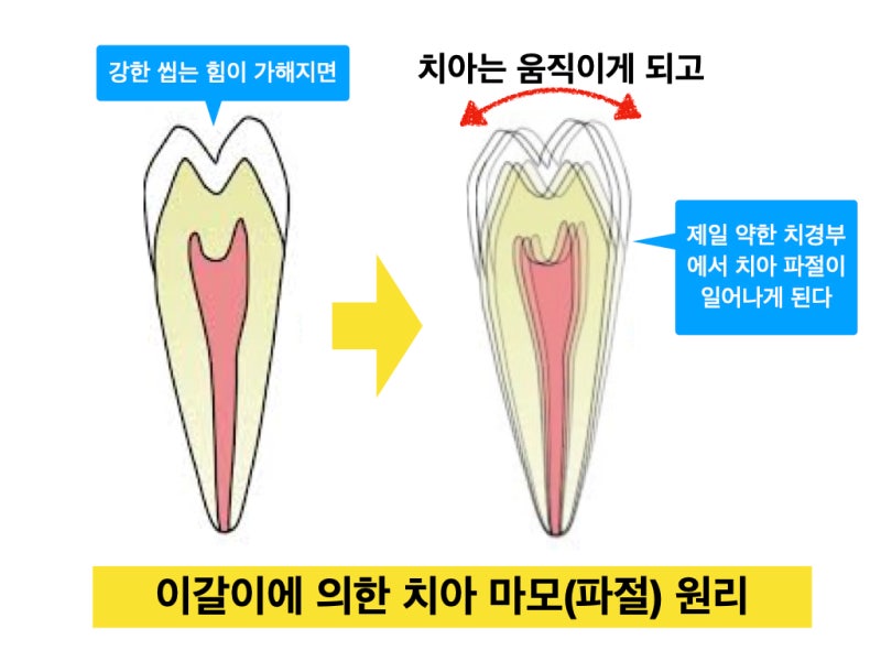 [치경부 마모, 치경부 레진]Part 1 치경부 마모증이 생기는 이유 3 가지 사진 3