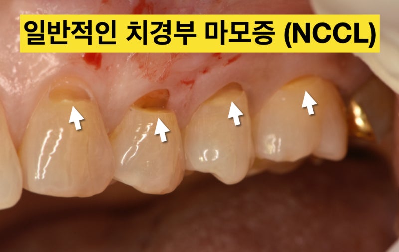 [치경부 마모, 치경부 레진]Part 1 치경부 마모증이 생기는 이유 3 가지