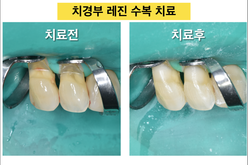 [치경부 마모, 치경부 레진]Part 2 치경부 마모증의 치료와 고려할 사항
