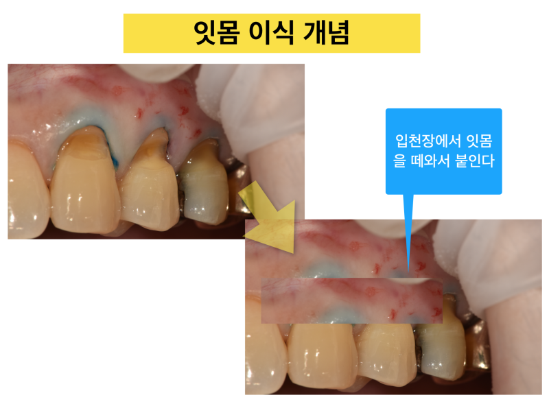 [치경부 마모, 치경부 레진]Part 2 치경부 마모증의 치료와 고려할 사항 사진 2