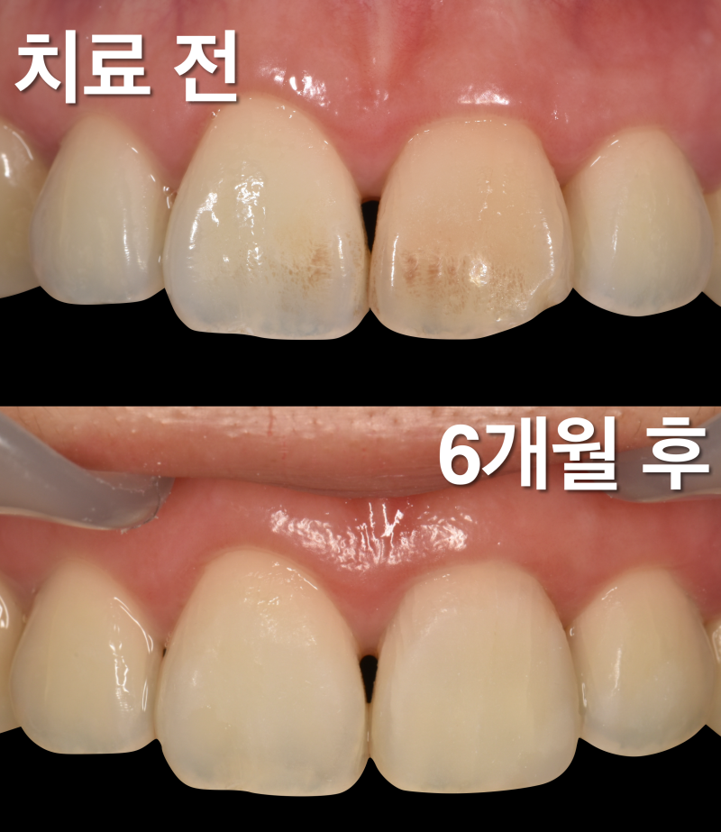 [치아 미백, 앞니 레진] 치아 하나만 변색되었을 때 해결법, 치아가 조금 깨졌을 때는 레진이 좋습니다 사진 4