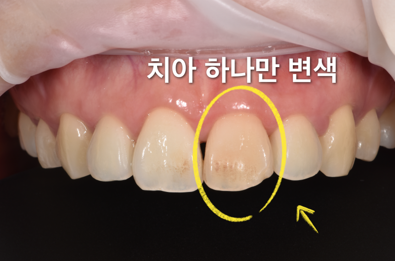 [치아 미백, 앞니 레진] 치아 하나만 변색되었을 때 해결법, 치아가 조금 깨졌을 때는 레진이 좋습니다