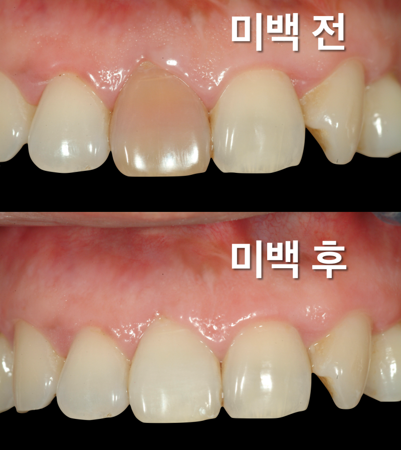[치아 미백 총정리] 잘 모르시는것, 궁금한 점 정리 사진 4