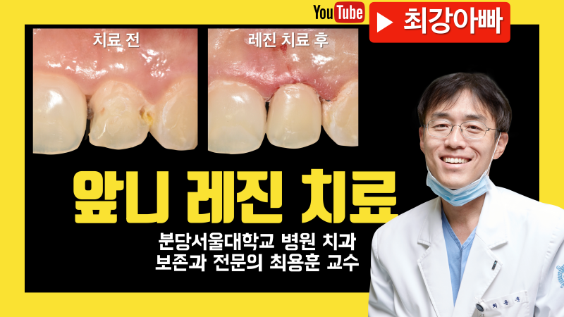 [앞니 레진] 범위가 작을 때는 레진 치료 추천하는 이유, 치료 과정