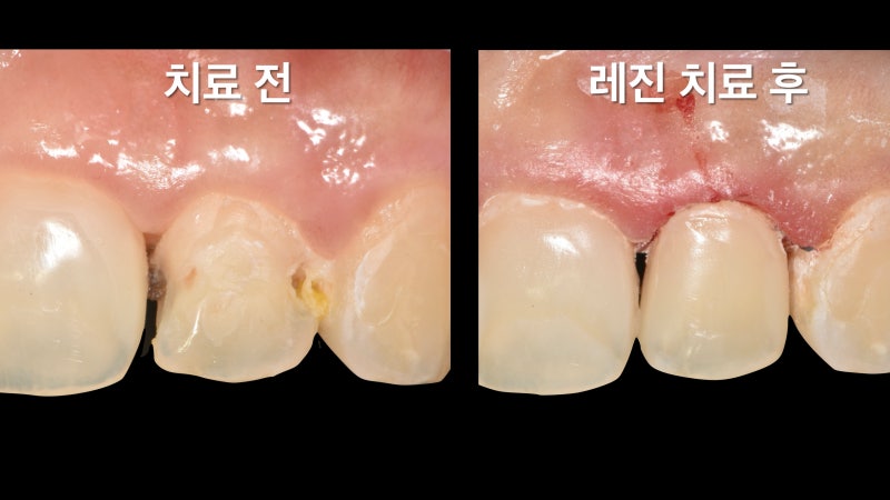 [앞니 레진] 범위가 작을 때는 레진 치료 추천하는 이유, 치료 과정