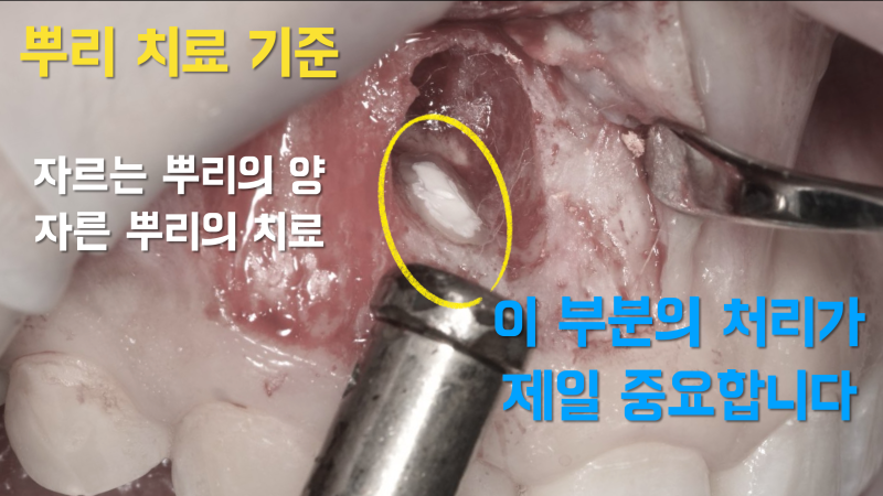 치근 절제술, 치근단 수술 기본 체크 사항 2가지