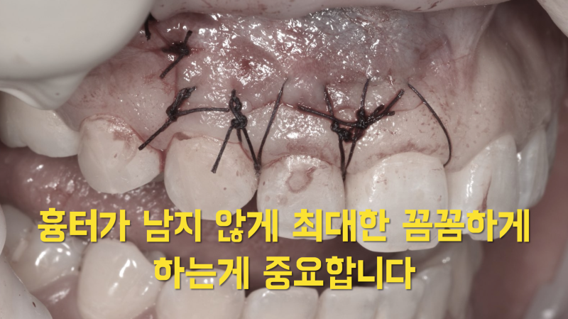 치근 절제술, 치근단 수술 기본 체크 사항 2가지 사진 4