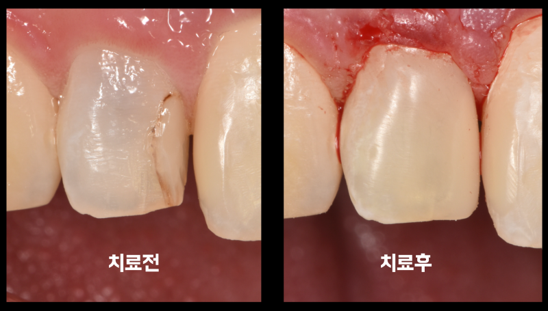 앞니는 크라운보다 레진을 고려해 보세요