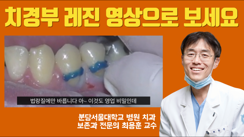 치경부 레진 치료 전체 과정 영상