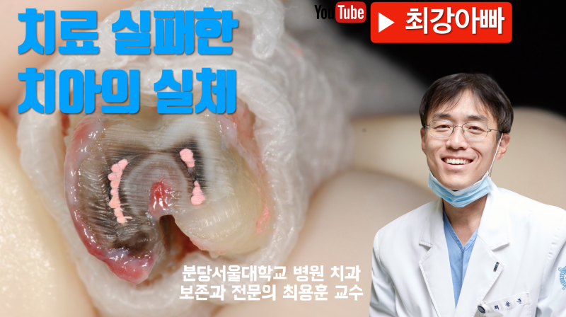 치아 재식술, 의도적 재식술 치아 내부 오염 파악이 중요하다