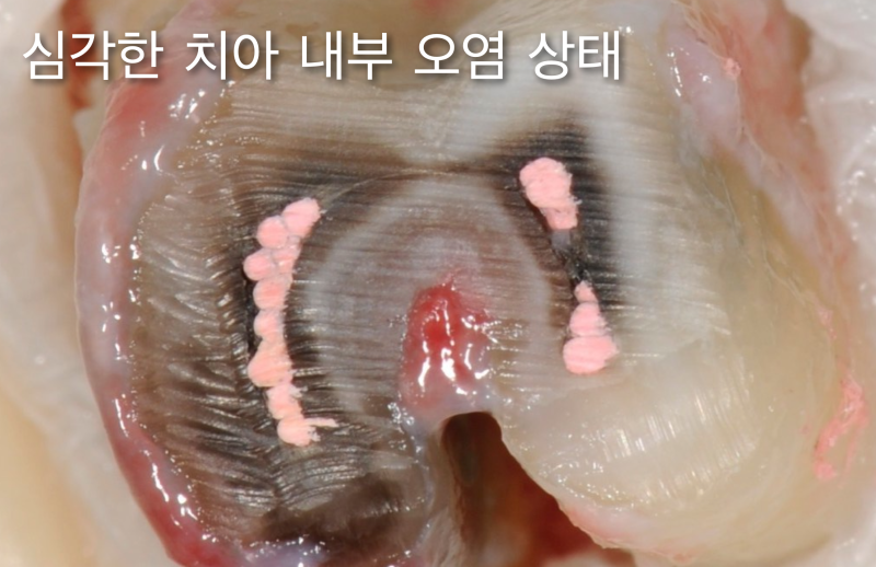 치아 재식술, 의도적 재식술 치아 내부 오염 파악이 중요하다