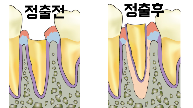 외과적 정출술 소개 사진 2
