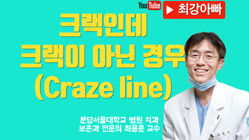 금이 간 치아인데 치료할 필요 없는 경우 (Craze line 과 Crack 의 차이)