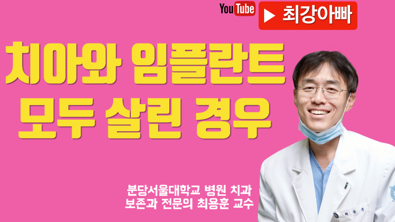 치아도 살리고 임플란트도 잘 하게 된 경우
