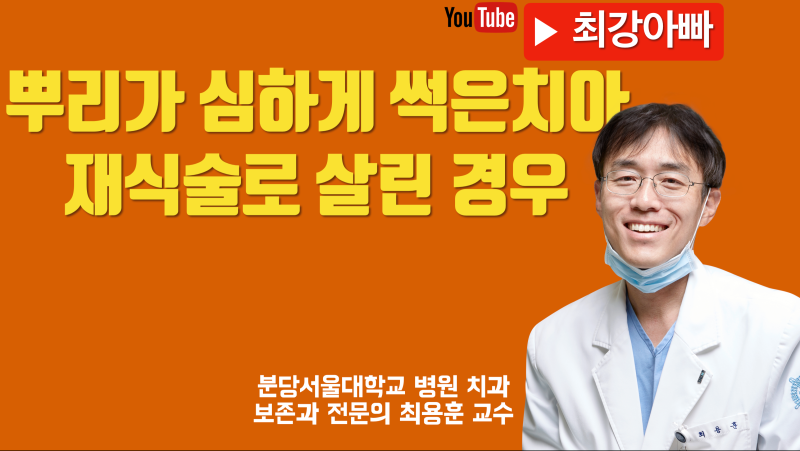 뿌리가 심하게 썩은 치아 살리기 #재식술 #치아살리기 #최용훈교수