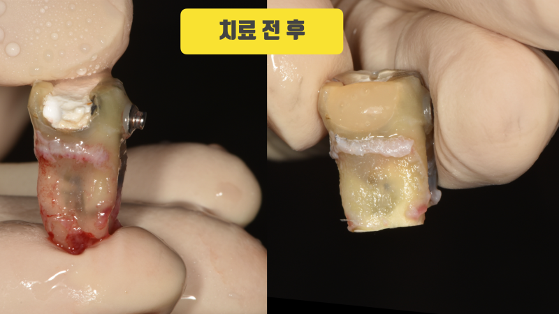 의료 사고로 망가진 치아 재식술로 살린 증례 #치아재식술 #의도적재식술