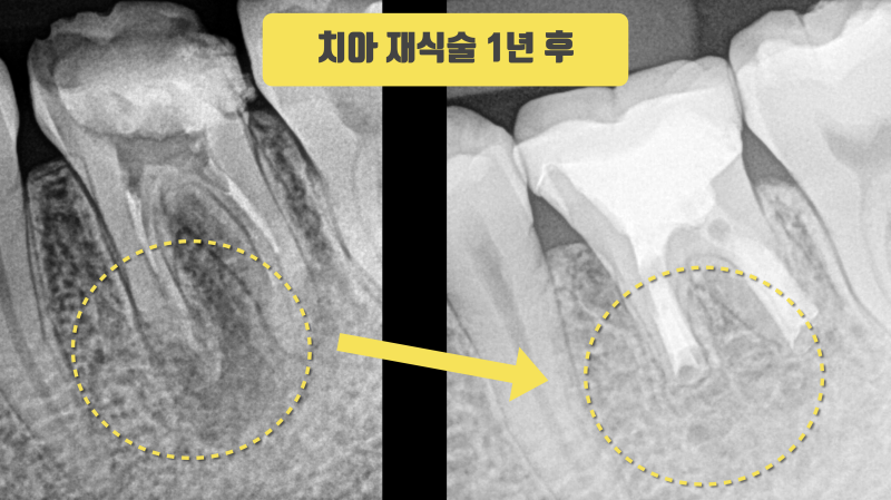 의료 사고로 망가진 치아 재식술로 살린 증례 #치아재식술 #의도적재식술 사진 4