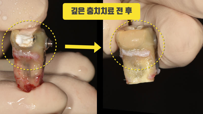 재식술만 가능한 깊은 충치의 치료 #치아재식술 #의도적재식술